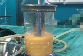 永康360度水动力吸脂费用多少钱？