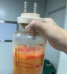 永康水动力吸脂手术要做多久？